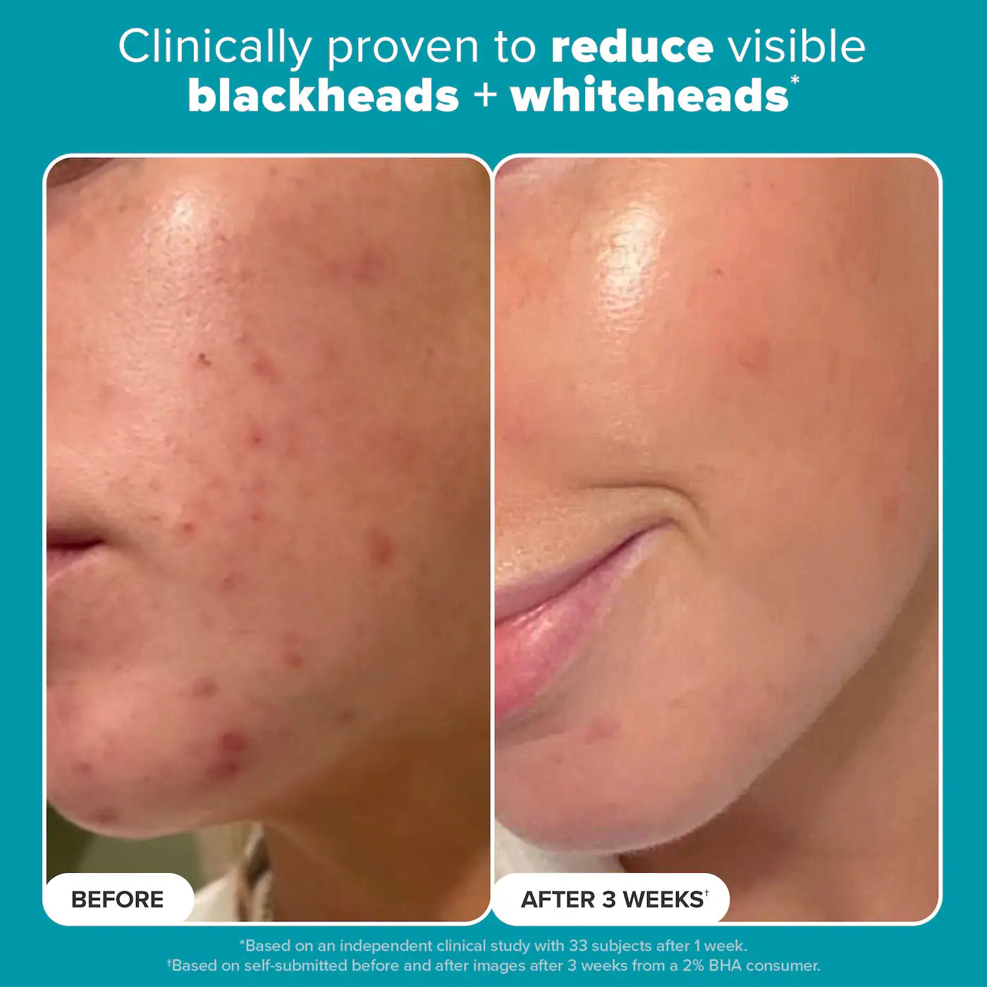 Skin Perfecting 2% BHA Exfoliating Toner for Clear Skin *PRE-ORDER*